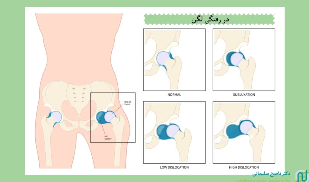 تشخیص در رفتگی لگن