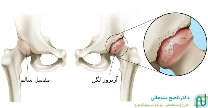 علائم و نشانه_های آرتروز لگن