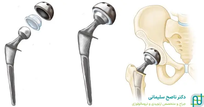 مزایای جراحی مجدد تعویض مفصل لگن