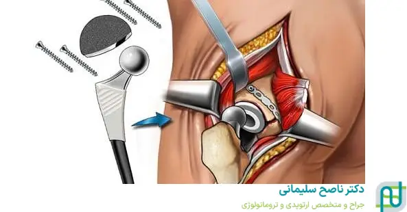 نحوه انجام جراحی مجدد تعویض مفصل لگن