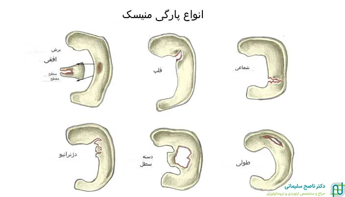انواع پارگی مینیسک زانو