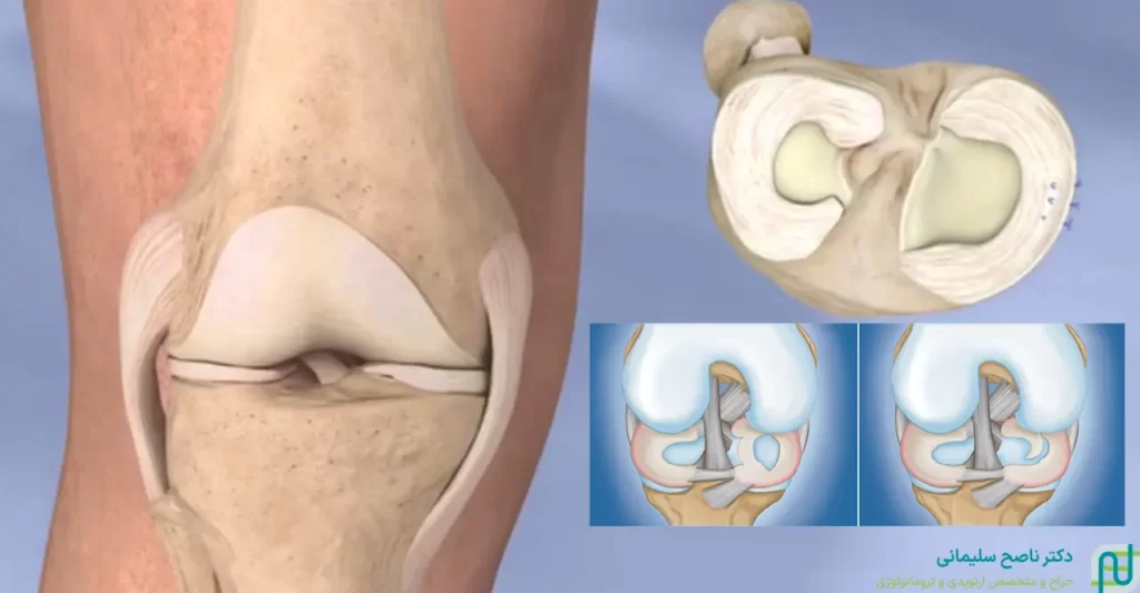 فاکتورهای خطر پارگی مینیسک زانو