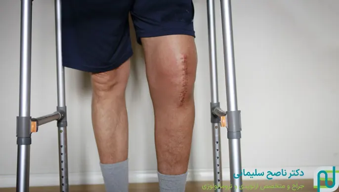 ورم بعد از عمل مینیسک زانو