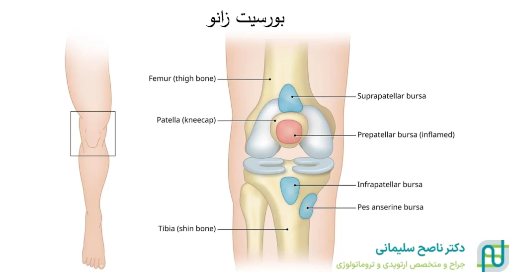 علت بروز بورسیت زانو
