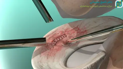 عمل ترمیمی منیسک زانو