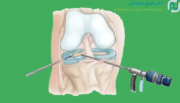 مراقبت‌های بعد از عمل ترمیم مینیسک زانو