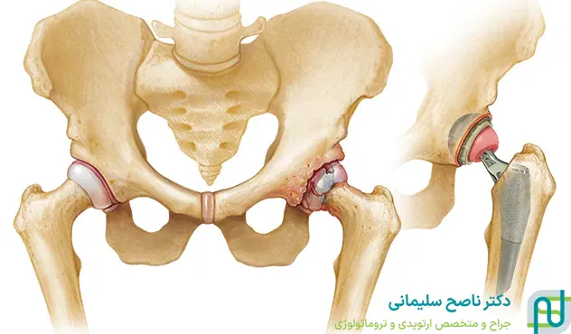 عوارض جراحی تعویض مفصل لگن 