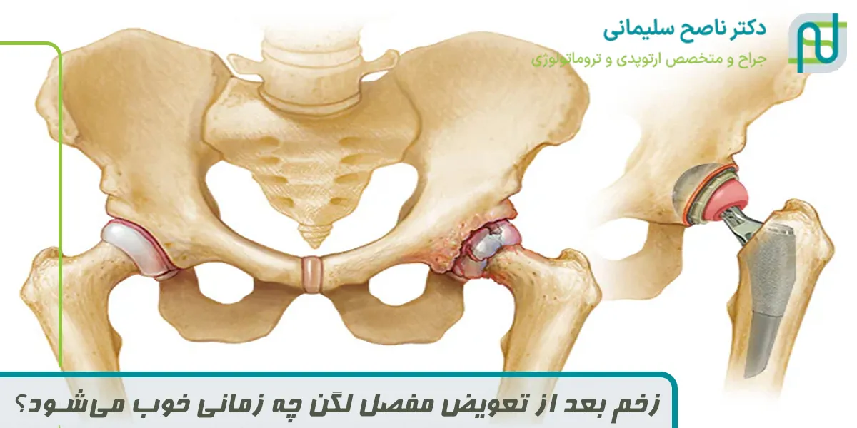 زخم بعد از تعویض مفصل لگن چه زمانی خوب می‌شود؟