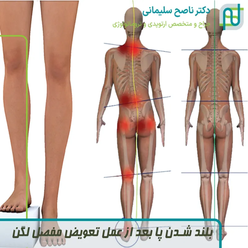 بلند شدن پا بعد از عمل تعویض مفصل لگن