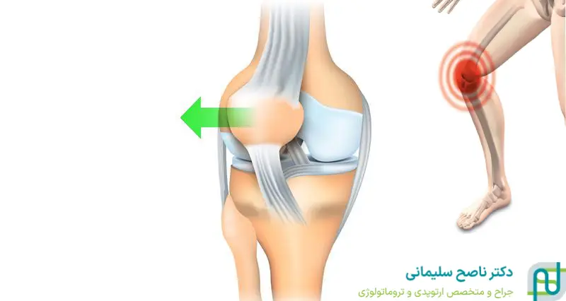 علائم ناپایداری کشکک زانو