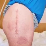 ورم پا بعد از عمل تعویض مفصل لگن