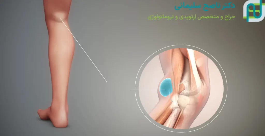علائم کیست بیکر