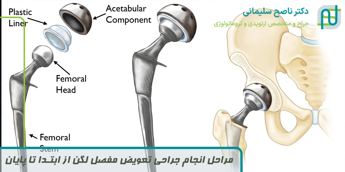 مراحل انجام جراحی تعویض مفصل لگن از ابتدا تا پایان