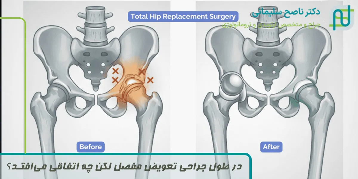در طول جراحی تعویض مفصل لگن چه اتفاقی می‌افتد؟