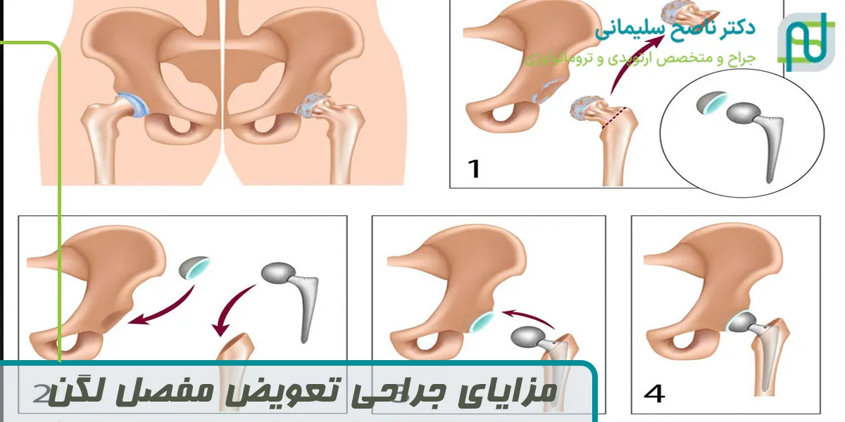 مزایای جراحی تعویض مفصل لگن