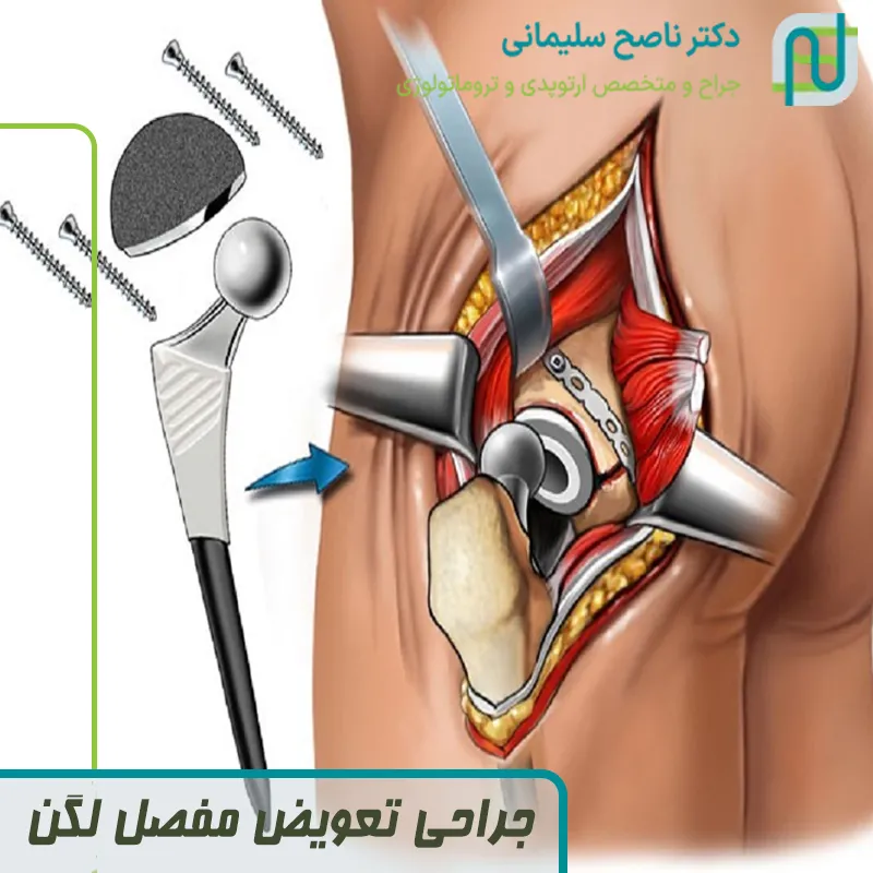 جراحی تعویض مفصل لگن