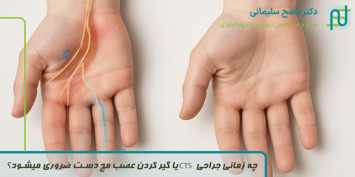 چه زمانی جراحی CTS  یا گیر کردن عصب مچ دست ضروری میشود