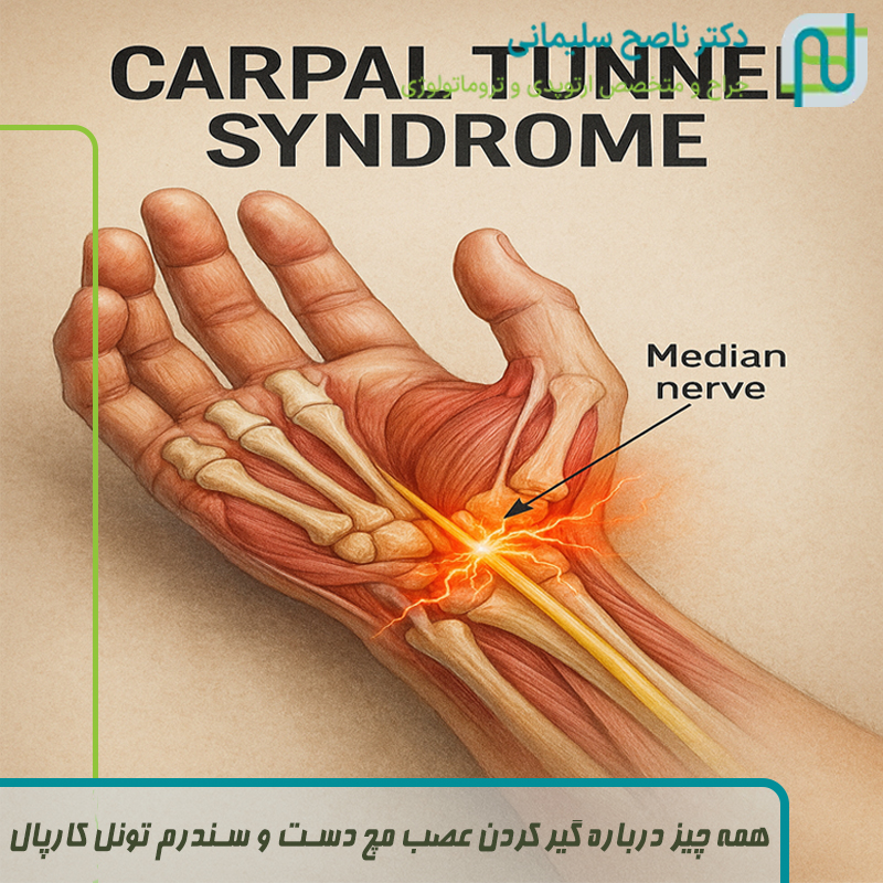 همه چیز درباره گیر کردن عصب مچ دست و سندرم تونل کارپال